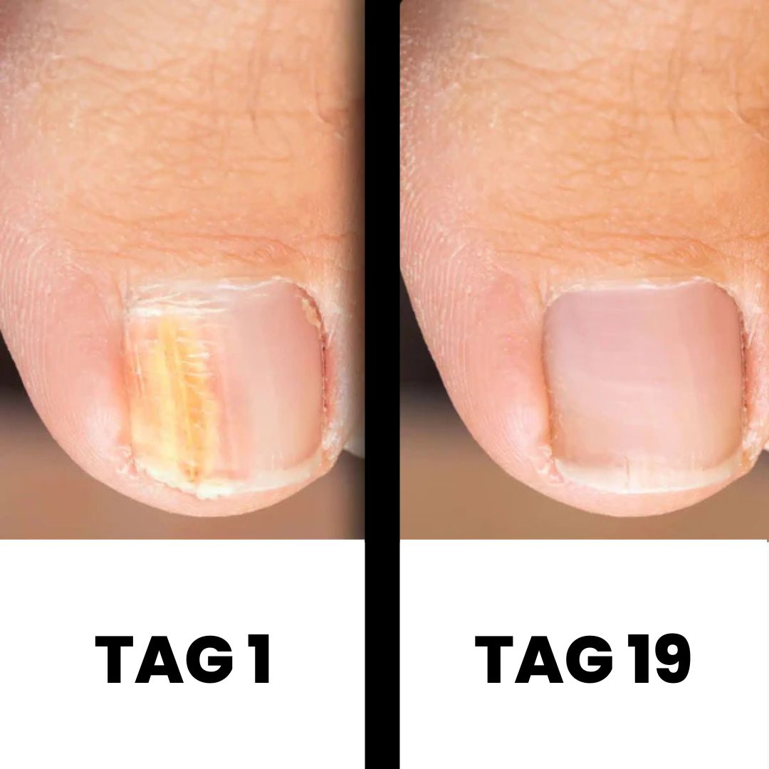 DermaNail - patentierte Nagelpilz-Therapie - für gesunde Nägel innerhalb von 4 Wochen